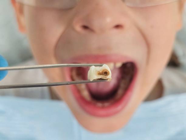 Best Emergency Dentist for Lost Fillings or Crowns in Maryland City, MD